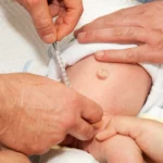 Caring for Your Baby after Circumcision