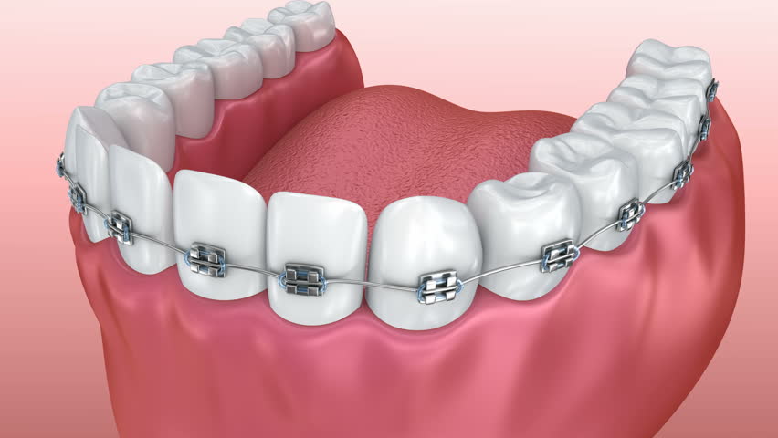 Why Are Braces Expensive? What Factors Influence the Cost
