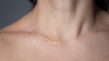 How to Prevent Scars: Tips for Minimizing Scar Formation?