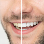 Keeping Your White Smile - Post-Whitening Care Tips from the Pros