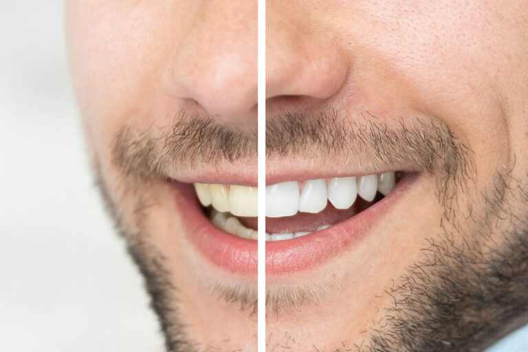 Keeping Your White Smile - Post-Whitening Care Tips from the Pros